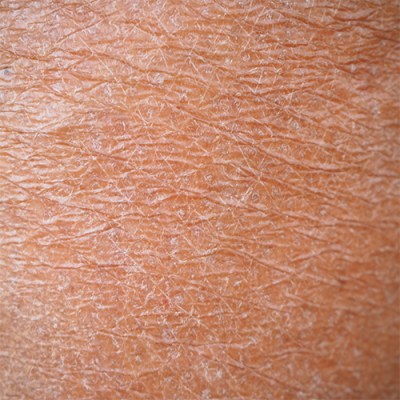 Dry Skin and Cancer